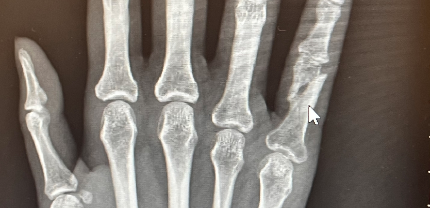 an xray of a weirdly set finger